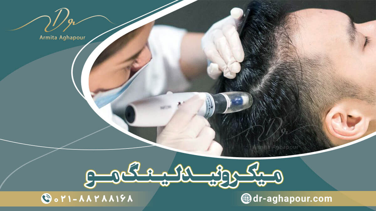 درمان ریزش مو با میکرونیدلینگ
